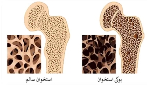 از از هر سه زن، یک نفر و از هر پنج مرد  یک نفر دچار شکستگی ناشی از پوکی استخوان می شود