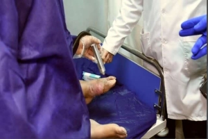 تصویر 1500 نفر تحت درمان پلاسما درمانی در مرکز مراقبت دیابت البرز قرار گرفتند